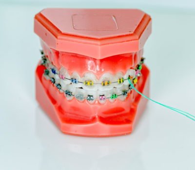 , Problemy z aparatem ortodontycznym &#8211; pierwsza pomoc