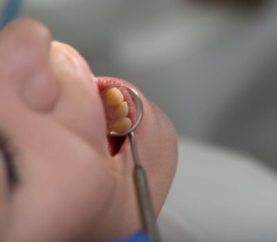 , Hiperdoncja- co zrobić w sytuacji nadliczbowych zębów?