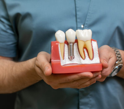 , Jak trwałe są implanty zębów?